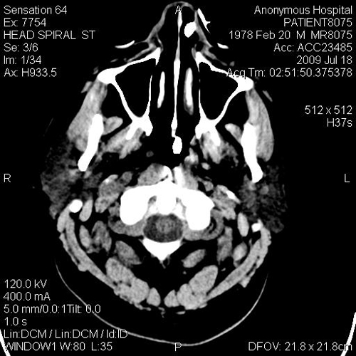 CT_brain_MR8075_spectra0003.jpg